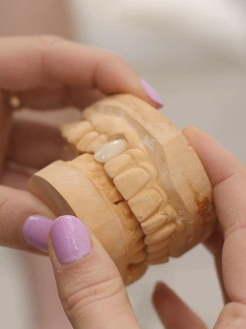 No prep veneers - 3Dental Dublin, Limerick & Galway